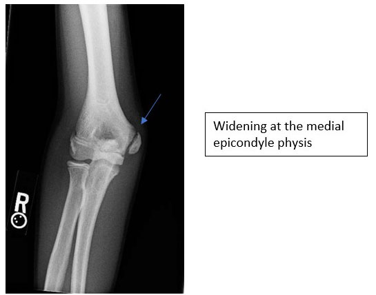 Medial Epicondyle Avulsion Fractures Apophysitis Elbow Surgery