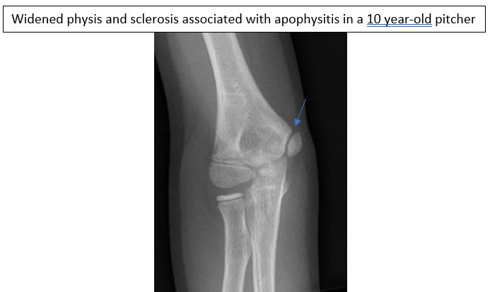 Medial Epicondyle Avulsion Fractures Apophysitis Elbow Surgery