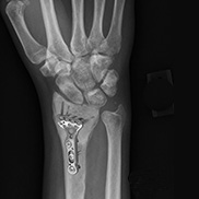 Wrist Open Reduction Internal Fixation Oklahoma City Wrist Fractures Edmond Norman Ok